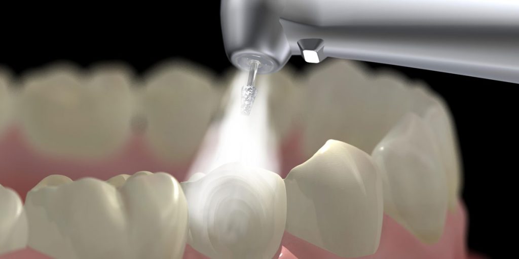 How to Care for Your Fillings