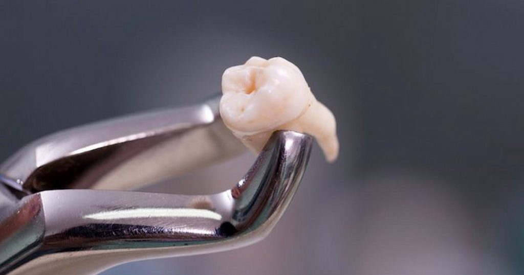 Wisdom Tooth Removal