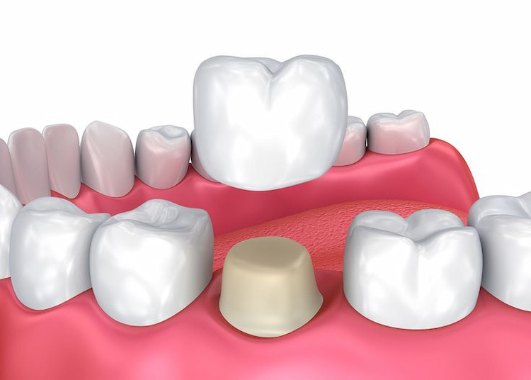 Most Common Dental Restoration Procedures