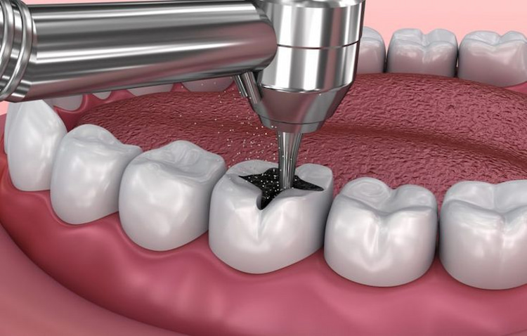 Most Common Dental Restoration Procedures