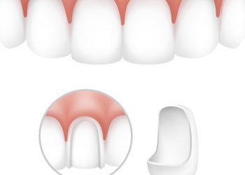 dental veneer