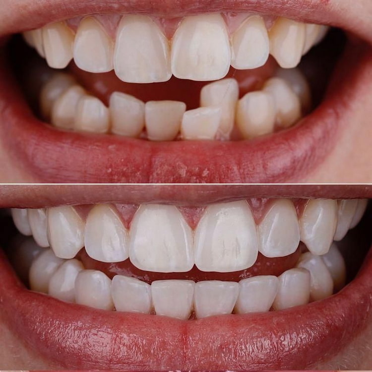 Crooked and Misaligned Teeth