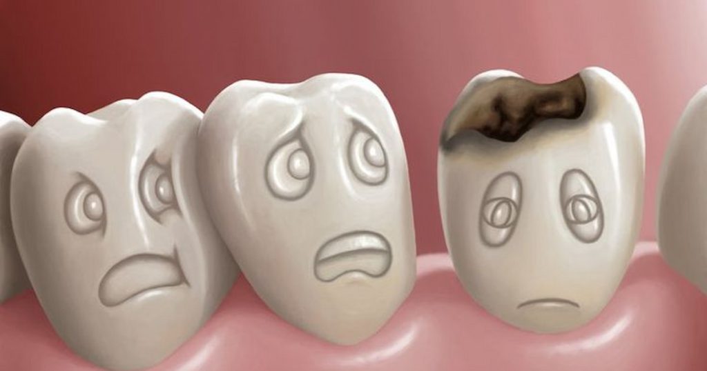 Tooth Decay