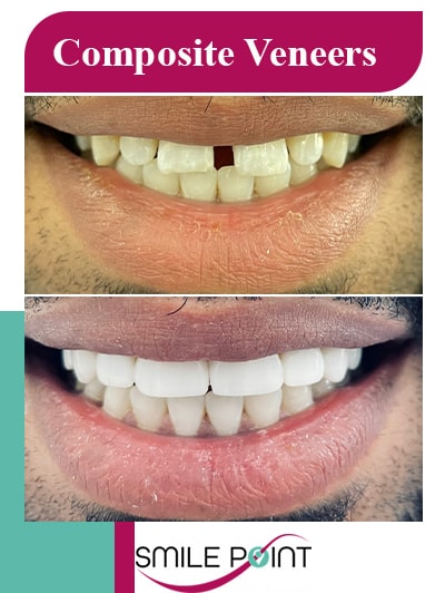 Composite Veneer in Oakville