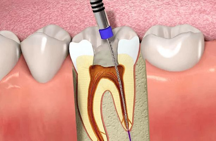 root canal for an abscessed tooth
