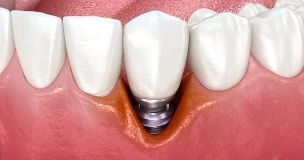 Common Dental Implant Complications