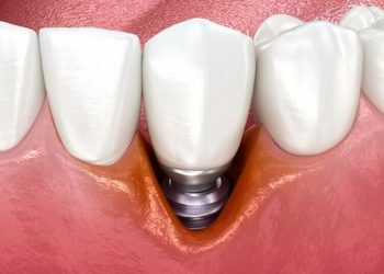 Common Dental Implant Complications