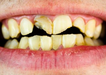 Cracked Tooth Repair