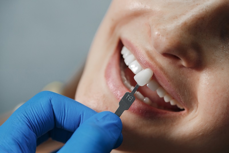 Who Can Benefit from Crowns and Bridges?