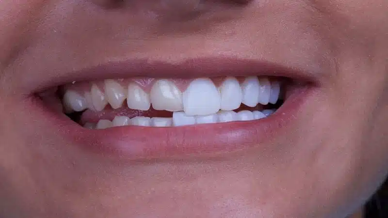 What Is the Difference Between Dental Bonding & Dental Veneers?
