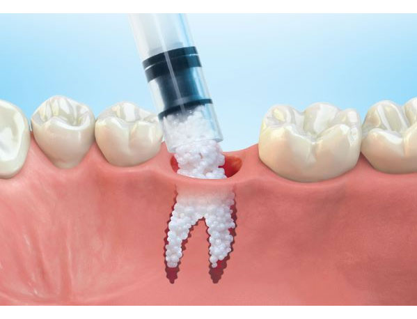Bone Grafting​