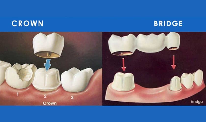 What Are Dental Crowns and Bridges?