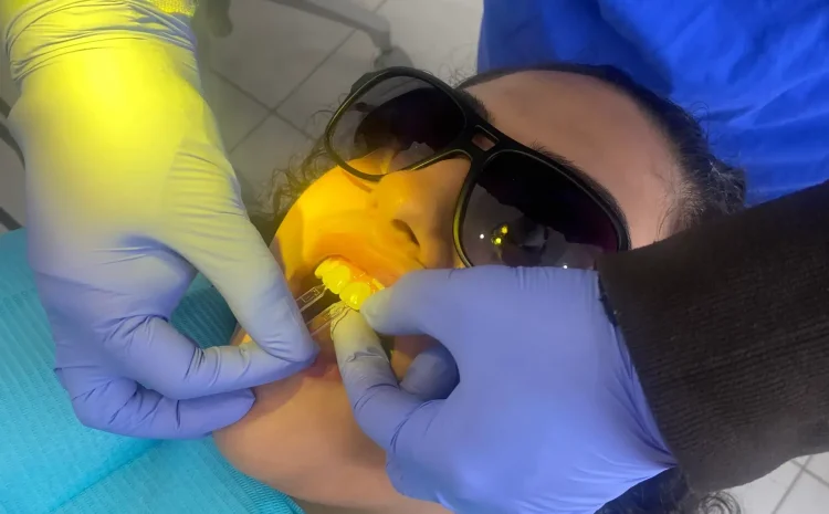 Ceramic Veneer in Oakville