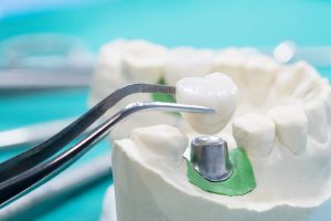 Dental Crowns and Bridges in Oakville