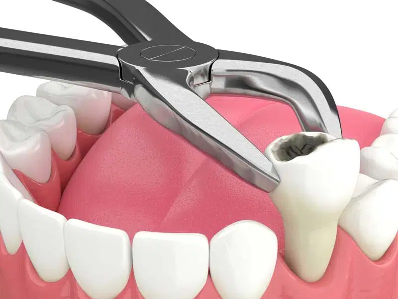 The Variety of Our Tooth Extraction Services in Oakville