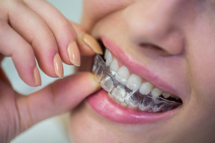 How Does Invisalign Work?