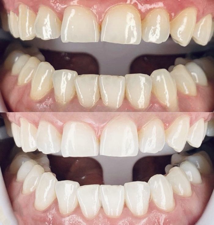 Teeth Whitening Before And After