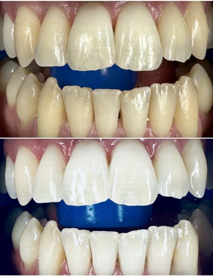 Teeth Whitening Before And After