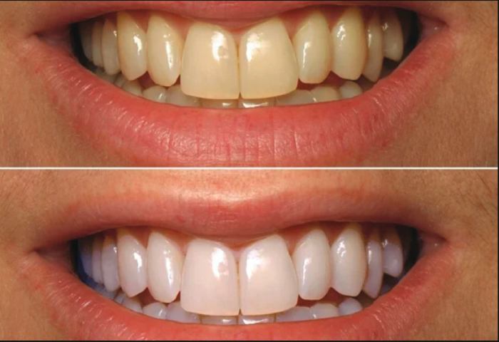 Teeth Whitening Before And After