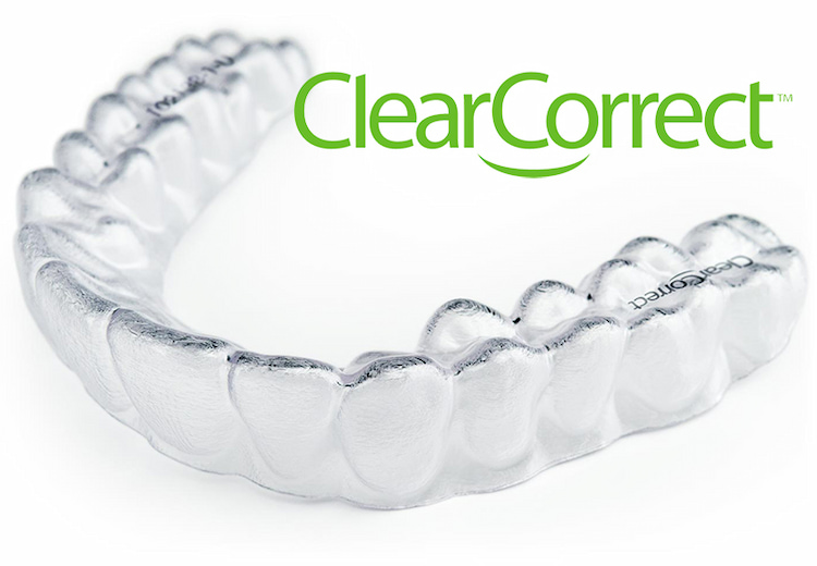 How to Get Started with Clear Aligners Treatment