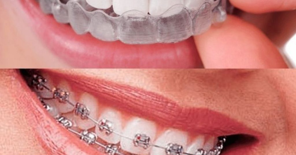 Best Invisalign Alternatives: Cost and Effectiveness Explained