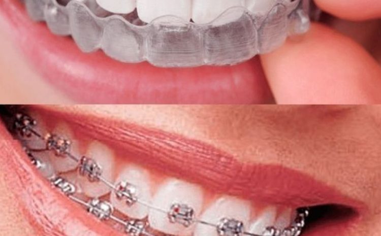  Best Invisalign Alternatives: Cost and Effectiveness Explained