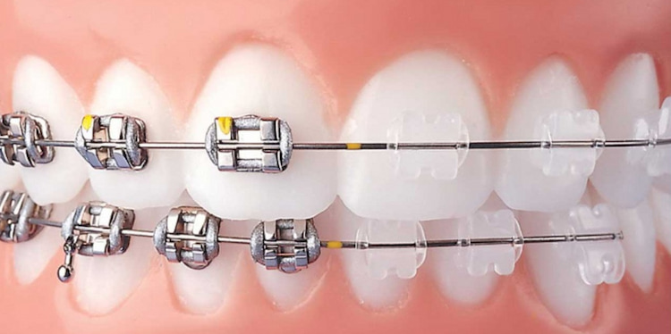 traditional braces