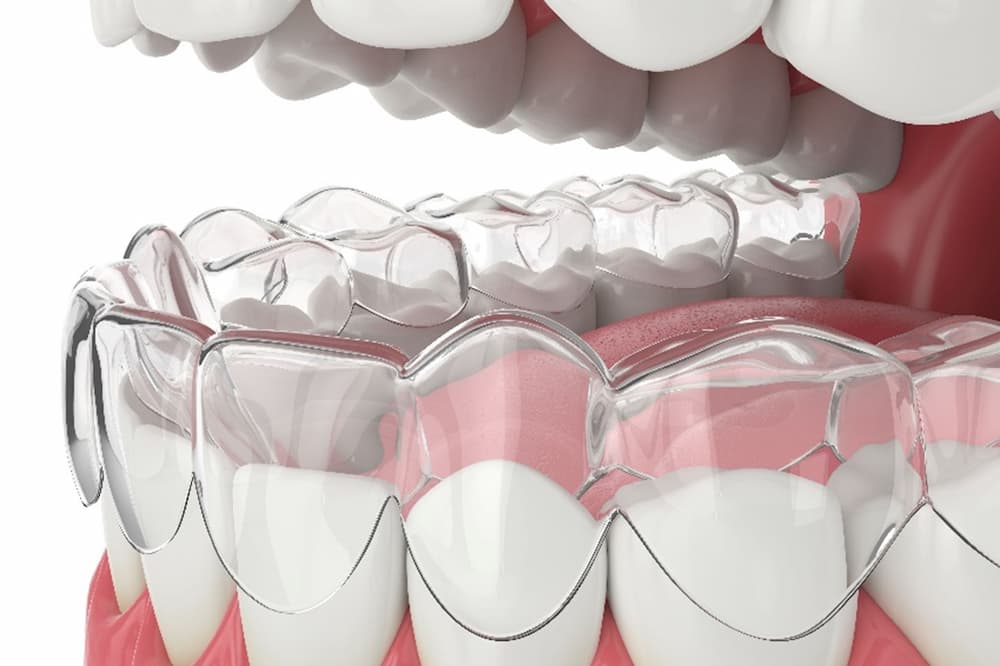Oakville Clear Aligners Treatment