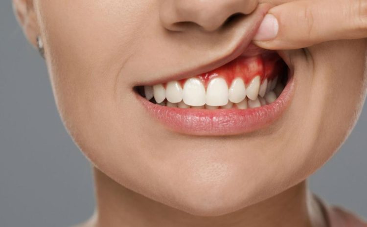  How to Treat Dental Abscess: Proven Solutions for a Healthier Smile