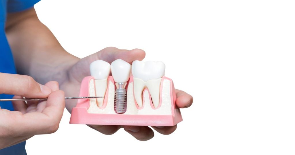 How much dental implant cost?