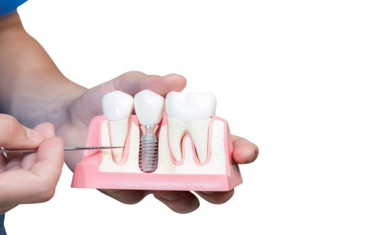  Dental Implants Cost Explained: What You’ll Really Pay and Why It’s Worth It