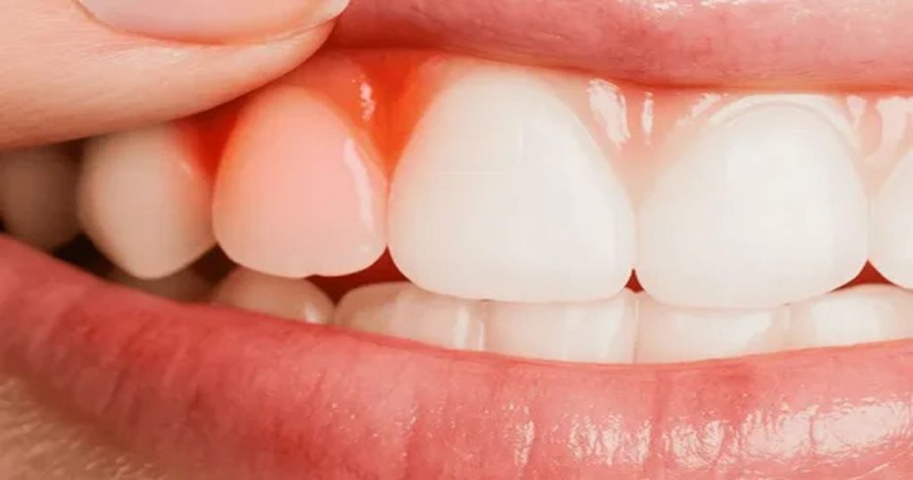 she wants to know the best antibiotic for gum infection