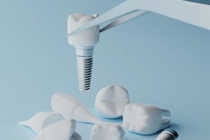Dental implants