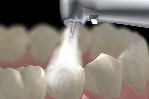 How to Care for Your Fillings